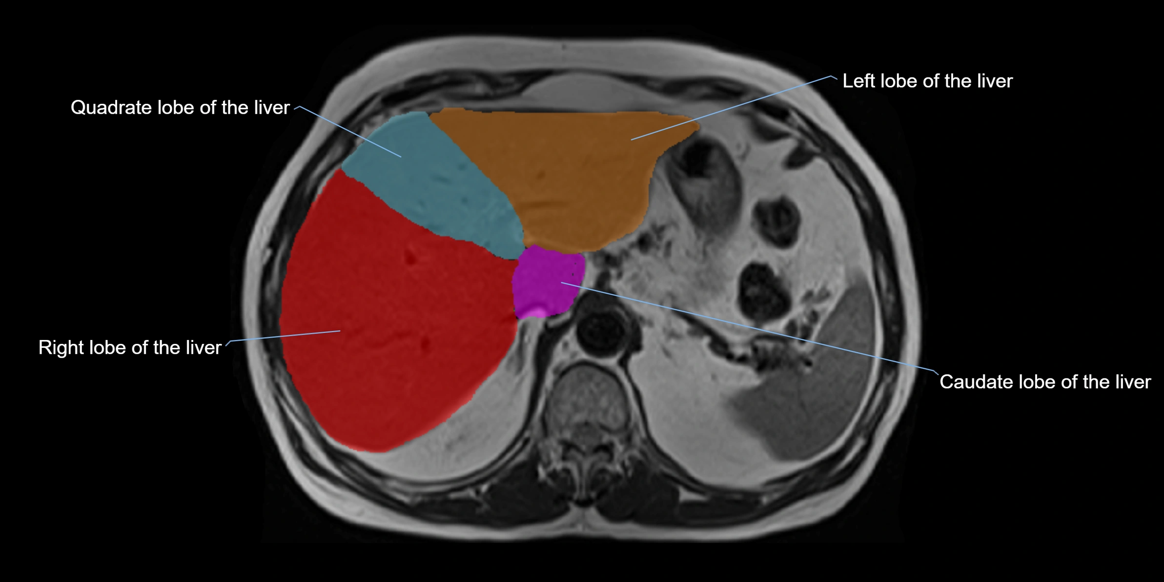 MRI liver lobe axial cross sectional 3T radiology  image-img-00001-00012.webp
